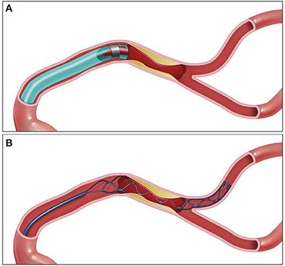 Rescue Endovascular Treatment for Emergent Large Vessel Occlusion With Underlying Intracranial Atherosclerosis: Current State and Future Directions